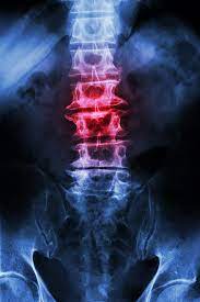 Lumbar Spondylosis Relief