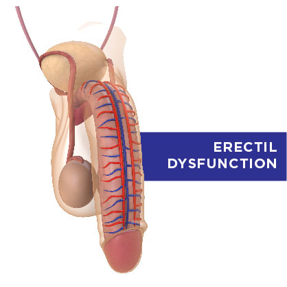 Erectile Dysfunction (ED) Support