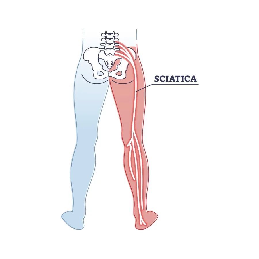 Sciatica
